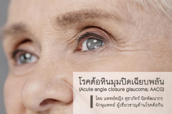 โรคต้อหินมุมปิดเฉียบพลัน(Acute angle closure glaucoma; AACG)